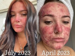 Jerawat yang Membuahkan Cinta di TikTok