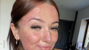 Foto: Influencer dengan Jerawat Semuka, Dipuji Berani Pamer Ketidaksempurnaan