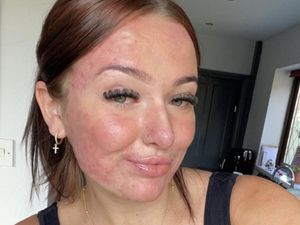 Foto: Influencer dengan Jerawat Semuka, Dipuji Berani Pamer Ketidaksempurnaan