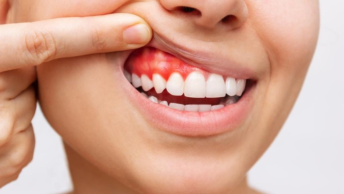 Ilustrasi radang gusi atau gingivitis. Ilustrasi radang gusi atau gingivitis.