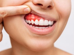 Gejala di Mulut Ini Bisa Jadi Tanda Diabetes, Kenali Ciri-cirinya