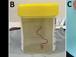 Penampakan Cacing Hidup 8 Cm Bersarang di Otak, Jadi Kasus Pertama di Dunia