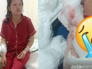 Emak-emak Strong di Palembang Lawan Begal hingga Tangan Robek Menganga