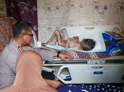 Bocah di Labuhanbatu Selatan Bertahun-tahun Menahan Sakit