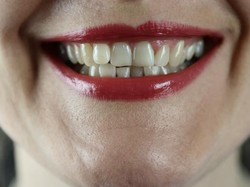 15 Cara Menghilangkan Gigi Kuning Membandel Secara Alami