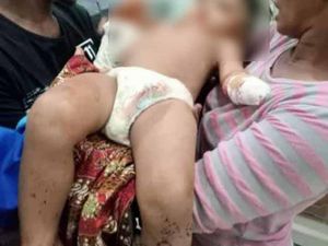 Tangan Bocah Sampang yang Putus gegara Mesin Tembakau Berhasil Disambung Tangan Bocah Sampang yang Putus gegara Mesin Tembakau Berhasil Disambung