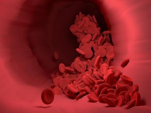 Anemia Sel Sabit Anemia Sel Sabit