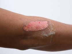 Jenis Derajat Luka Bakar: Tanda, Penyebab, dan Cara Penanganannya