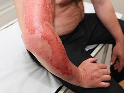 3 Jenis Derajat Luka Bakar dan Cara Perawatannya