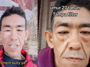 Curhat Pria di Aceh Idap Sindrom Langka, Usia 29 Tapi Wajah Bak 80 Tahun Curhat Pria di Aceh Idap Sindrom Langka, Usia 29 Tapi Wajah Bak 80 Tahun