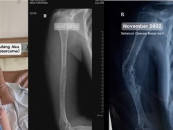 Cerita Wanita Ketahuan Kena Kanker Tulang gegara Sering Pegal-pegal