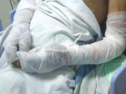 Kondisi Terkini 2 Relawan Luka saat Tangani Kebakaran Lahan Perhutani Klaten