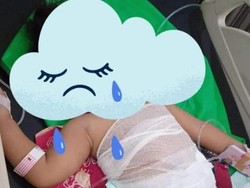 4 Fakta Nelangsa Balita Ponorogo Tercebur Panci Isi Sayur Panas