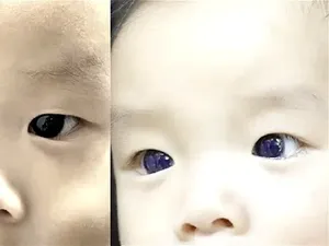 Mata Cokelat Bayi di Thailand Berubah Biru Setelah Pengobatan COVID-19
