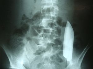 Lagi! Benda Aneh Bersarang di Tubuh, Kali Ini Pisau Nyangkut di Perut