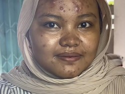Viral Pengantin Wajahnya Banyak Jerawat Batu, Setelah Dimakeup Bikin Kaget