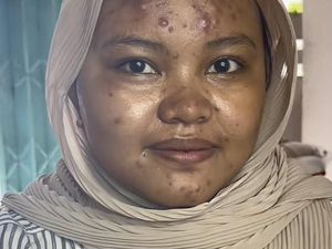 Viral Pengantin Wajahnya Banyak Jerawat Batu, Setelah Dimakeup Bikin Kaget Viral Pengantin Wajahnya Banyak Jerawat Batu, Setelah Dimakeup Bikin Kaget
