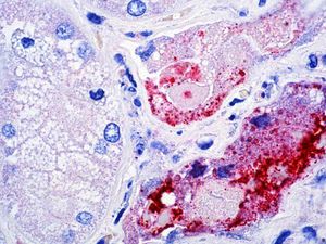 Yang Perlu Anda Ketahui tentang Wabah Virus Nipah di India