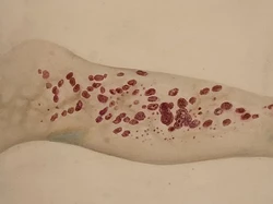 Penyakit Lama yang Comeback di AS