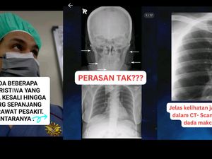Tak Cuma di Negeri Jiran, Kasus Pasien dengan Susuk Juga Ada di Indonesia Tak Cuma di Negeri Jiran, Kasus Pasien dengan Susuk Juga Ada di Indonesia