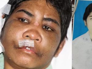 Penyiksaan TKI Asal NTT di Malaysia, Kepala Korban Retak-Muka Lebam Penyiksaan TKI Asal NTT di Malaysia, Kepala Korban Retak-Muka Lebam