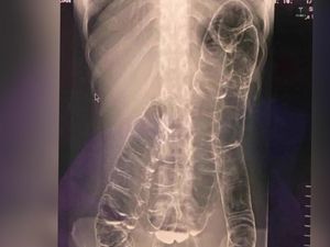 Fakta-fakta Foto Usus Pasien Naik ke Dada, Disebut gegara Sembelit Parah Fakta-fakta Foto Usus Pasien Naik ke Dada, Disebut gegara Sembelit Parah
