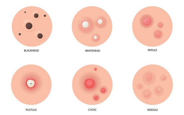 Potret ilustrasi masalah kulit akibat purging/ Foto: freepik.com Potret ilustrasi masalah kulit akibat purging