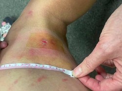 Cerita Turis Kena Tomcat di Bali hingga Kakinya Melepuh