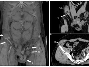 Testis Pria Ini Pindah ke Perut Imbas Kecelakaan Motor, Begini Penampakannya