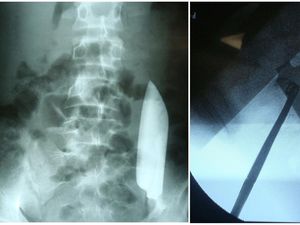Keluhkan Sakit Perut, Ternyata Ada Pisau 15 Cm Nyangkut di Perut Pria Ini