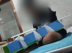 6 Fakta Siswa SMP Banyuwangi Dianiaya Teman hingga Tulang Retak