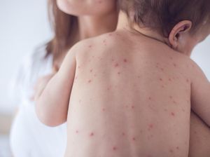 5 Obat Cacar Air Alami, Bisa Bantu Redakan Gejalanya dengan Cepat 5 Obat Cacar Air Alami, Bisa Bantu Redakan Gejalanya dengan Cepat