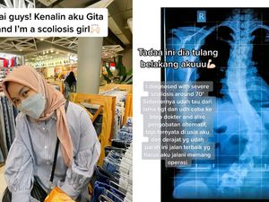 Curhat Wanita Bandung Idap Skoliosis, Punggung Bengkok Hingga 70 Derajat Curhat Wanita Bandung Idap Skoliosis, Punggung Bengkok Hingga 70 Derajat