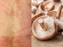 Gegara Makan Jamur Kurang Matang, Pria Ini Alami Ruam di Seluruh Punggung