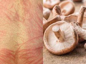 Gegara Makan Jamur Kurang Matang, Pria Ini Alami Ruam di Seluruh Punggung Gegara Makan Jamur Kurang Matang, Pria Ini Alami Ruam di Seluruh Punggung