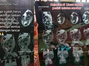 Viral Bayi 5 Bulan Hamil Diduga Fetus in Fetu, Kondisi Apa Itu? Viral Bayi 5 Bulan Hamil Diduga Fetus in Fetu, Kondisi Apa Itu?