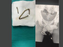 Ngeri, Pria Ini Nekat Tancapkan 2 Paku ke Testis gegara Disuruh Teman Khayalan