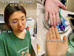 Kebanyakan Makan Wortel untuk Diet, Kulit Wanita Ini jadi Oranye