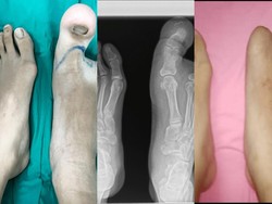 Anak Perempuan Ini Idap Penyakit Langka, Jempol Kakinya Besar Sebelah