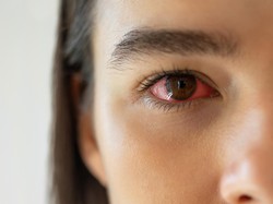 Viral Bocah SD di Palembang Alami Mata Lebam dan Merah