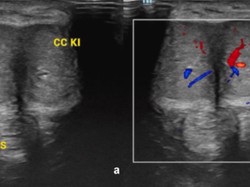 Kisah Pria Ereksi Seminggu Ternyata gegara Kanker, Berujung Diamputasi