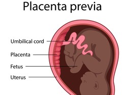Plasenta Previa: Jenis, Penyebab, Gejala, dan Cara Mencegahnya