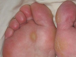 10 Cara Menghilangkan Kapalan di Kaki dengan Cepat di Rumah