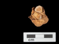 Tumor Ovarium Langka Bergigi Ditemukan pada Mumi Wanita Mesir Usia 3.000 Tahun