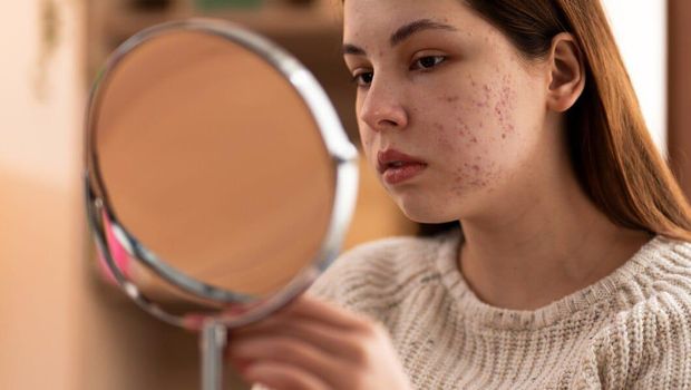 Cara menghilangkan jerawat batu secara alami/ foto: www.freepik.com