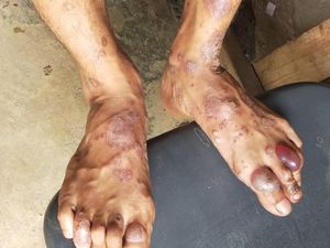 Ciri-ciri Cacar Monyet, Gejala, Penyebab, dan Penanganannya Ciri-ciri Cacar Monyet, Gejala, Penyebab, dan Penanganannya