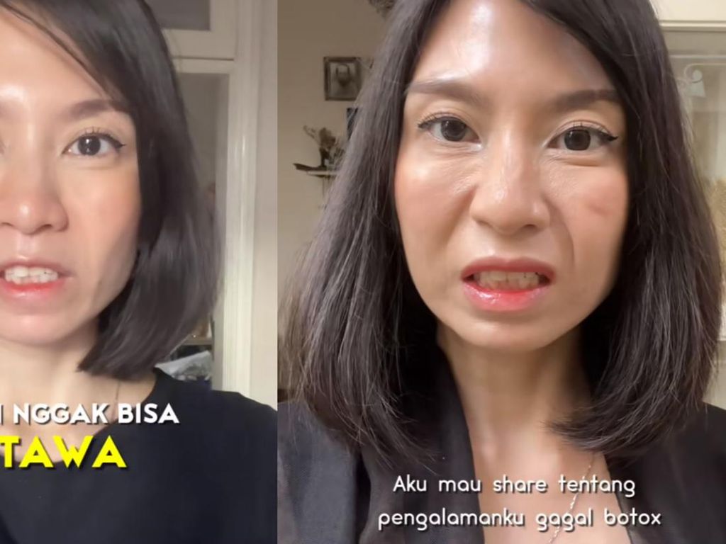 Viral Wajah Wanita Solo Jadi Kaku, Ini Saran Dokter Biar Tak Terjadi Gagal Botox