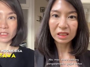 Viral Wajah Wanita Solo Jadi Kaku, Ini Saran Dokter Biar Tak Terjadi Gagal Botox Viral Wajah Wanita Solo Jadi Kaku, Ini Saran Dokter Biar Tak Terjadi Gagal Botox