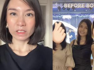 Before-After Viral Wanita Gagal Botox Berujung Tak Bisa Tertawa 4 Bulan Before-After Viral Wanita Gagal Botox Berujung Tak Bisa Tertawa 4 Bulan