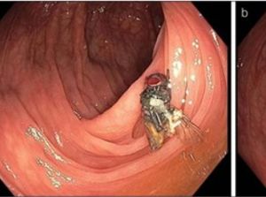 Hii... Daftar Temuan Benda Aneh di Tubuh Manusia, Lalat Hidup hingga Kelapa Utuh